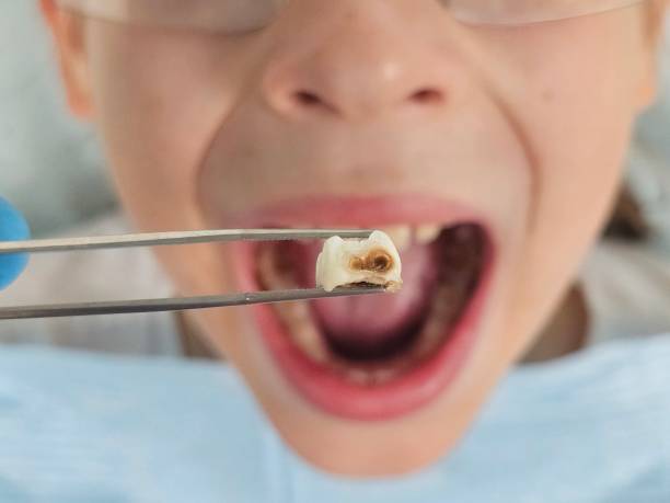 Best Chipped Tooth Repair Near Me  in Farmington, MN